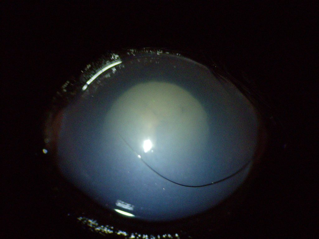 Következményes glaucoma