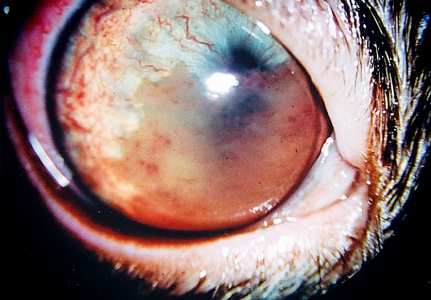 Uveitis